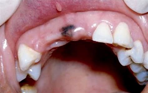 oral melanotic macule - pictures, photos