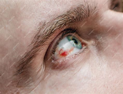 Premium Photo | The eye of a man with a bursting vessel in the eyeball ...