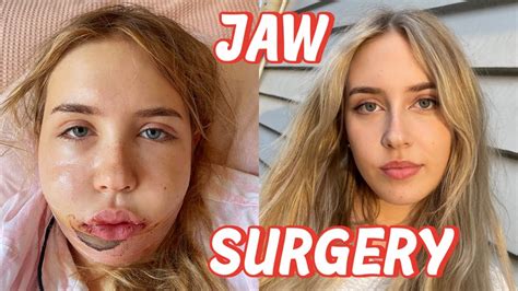 I had Double Jaw Surgery | VLOG & recovery - YouTube