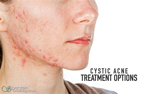 Cystic Acne Treatment | vlr.eng.br