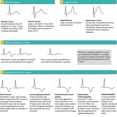 ECG interpretation: Characteristics of the normal ECG (P-wave, QRS ...