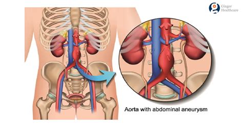 Abdominal Aortic Aneurysm: Symptoms, Causes, Diagnosis & Treatment Options