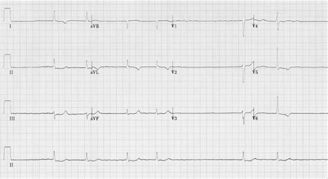 Atrial Fibrillation • LITFL • ECG Library Diagnosis