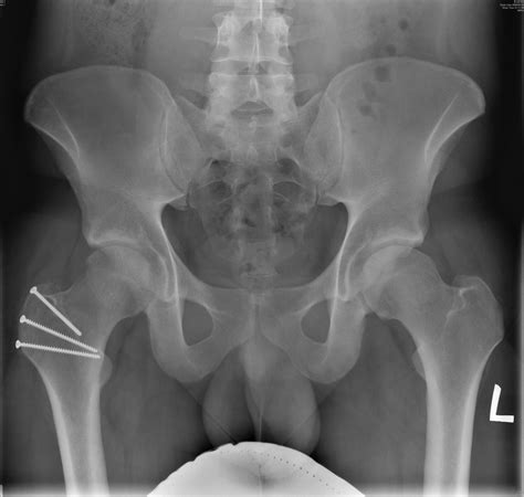 Open Surgical Dislocation Hip | Orthowood