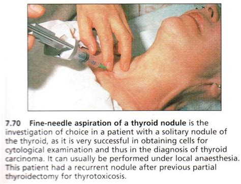 10,000 Strong Against Thyroid Cancer: STUDY: c-KIT receptor expression ...