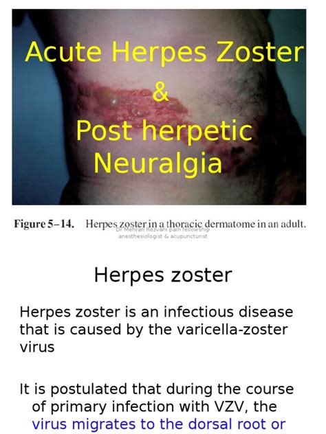 Post Herpetic Neuralgia and Herpes Zoster | Symptoms And Signs: General ...