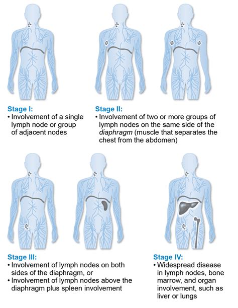 Staging and Prognosis | Lymphoma Research Foundation