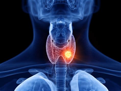 Prognostic Importance of Advanced Pathological Features in Papillary ...