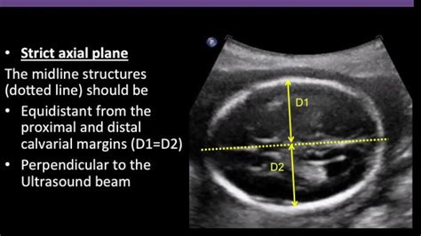 Fetal Lateral Ventricle Measurement Ultrasound