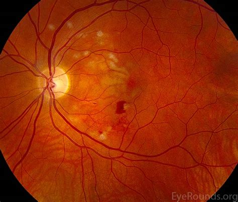 Atlas Entry - Purtscher Retinopathy