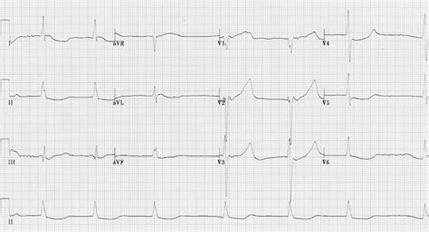 QT Interval • LITFL • ECG Library Basics