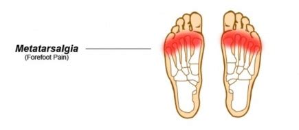 Metatarsalgia - Physiopedia