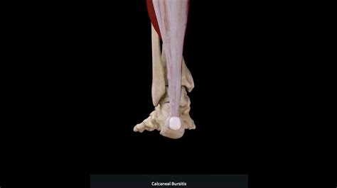 Calcaneal Bursitis | George Gendy MD