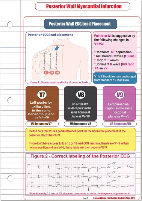 ECG Educator Blog : Posterior ECG Lead Placement