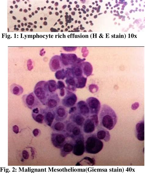 Table 5 from Study of pleural fluid cytology in a tertiary care ...