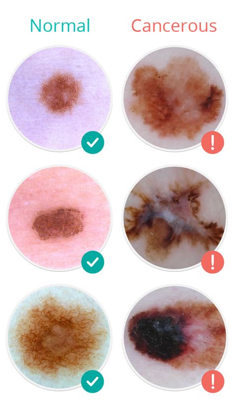 MoleScope™ | Skin Cancer Signs & Symptoms