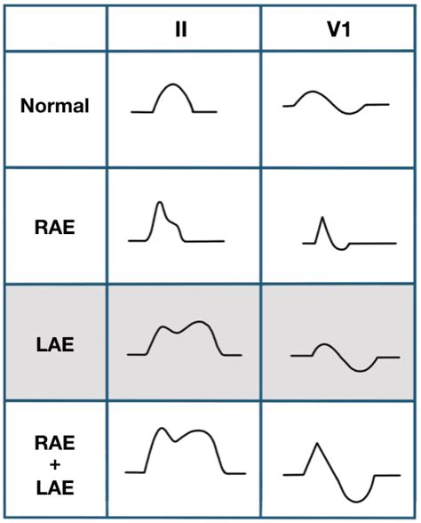 Left Atrial Enlargement • LITFL Medical Blog • ECG Library Basics