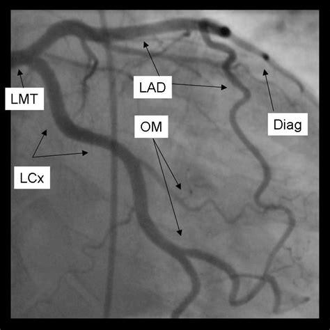 Coronary angiography standard views - wikidoc | Coronary arteries ...