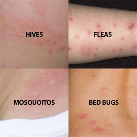 bed bug bites what do they look like - BC Bed Bug Expert