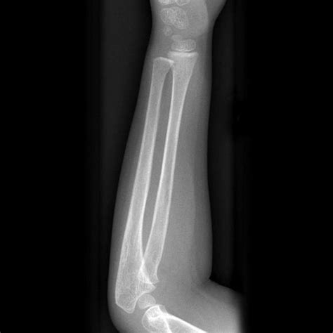 Normal Bone (Radius and Ulna) | Download Scientific Diagram