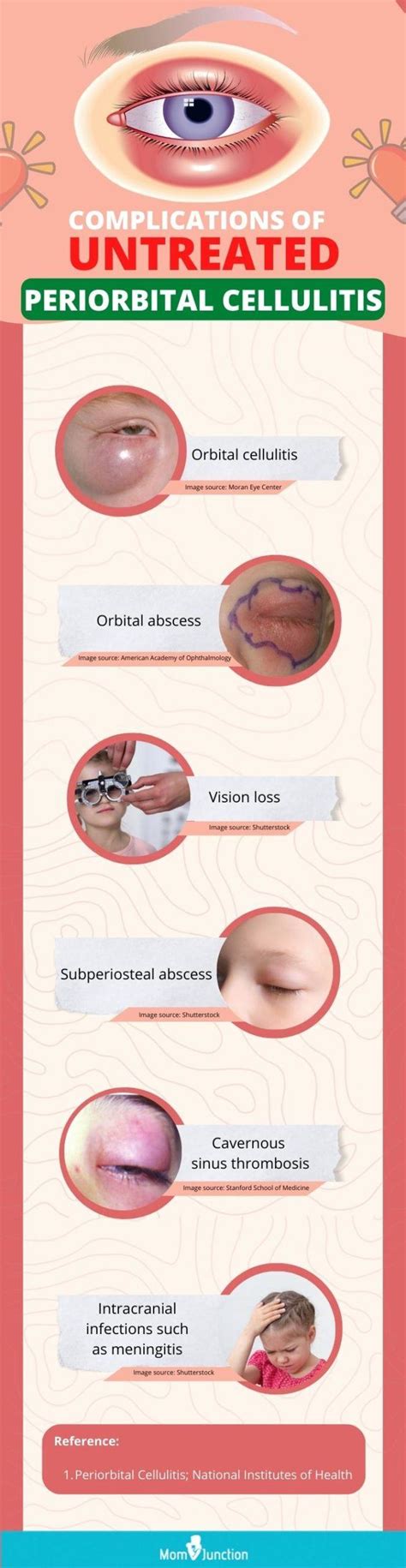 Symptoms And Causes Of Periorbital Cellulitis In Children