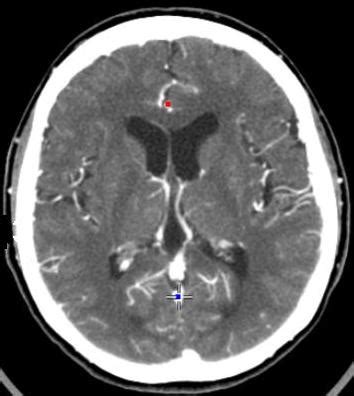 CT Brain with or without Contrast | Cedars-Sinai