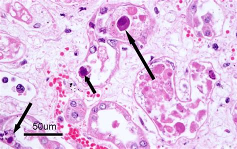 The three types of inclusion bodies: Cowdry A(long arrow), full-type ...