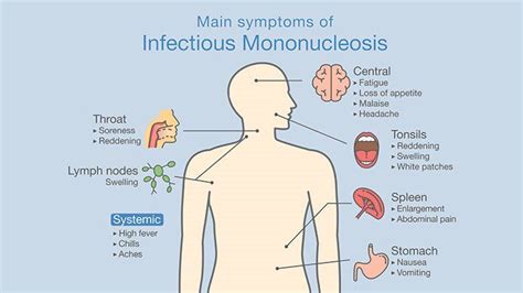 A Brief Recap of Infectious Mononucleosis in Athletes - Sports Medicine ...