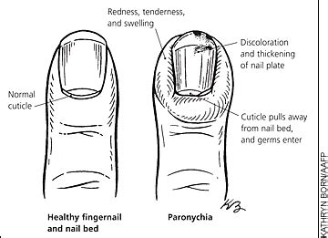 Top more than 127 infection around nail - noithatsi.vn