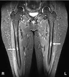 Femur Stress Fracture Mri