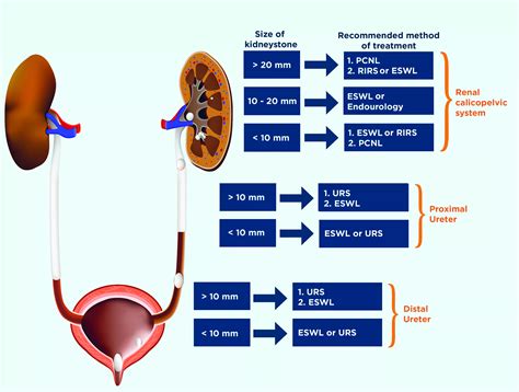 Which Kidney Stone Treatment Method is Right for Me? — Dornier MedTech