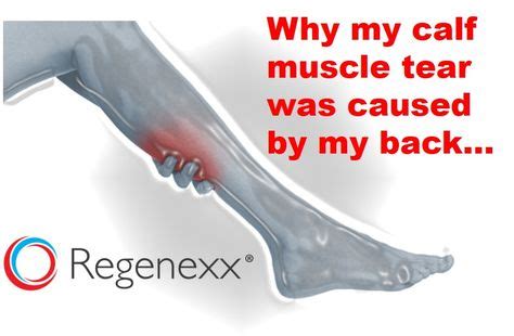 Why my calf muscle tear was caused by my back and why yours may have ...