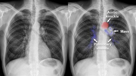 Hilum Chest X Ray