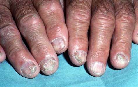 Nail fungus infection, causes and how to get rid of nail fungus infection