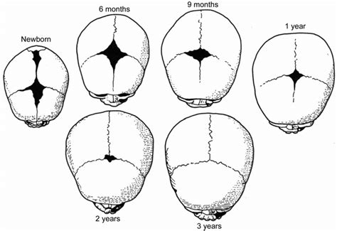 1 Developmental stages of fontanelle closure between birth and 3 years ...