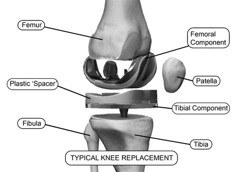 Illustration of Typical Knee Replacement, Hardware Components Re – Hip ...