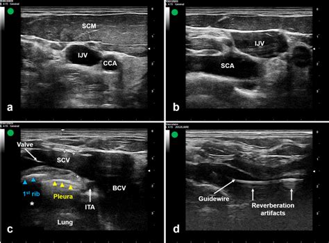 Ultrasound-guided subclavian vein catheterization using the long-axis ...