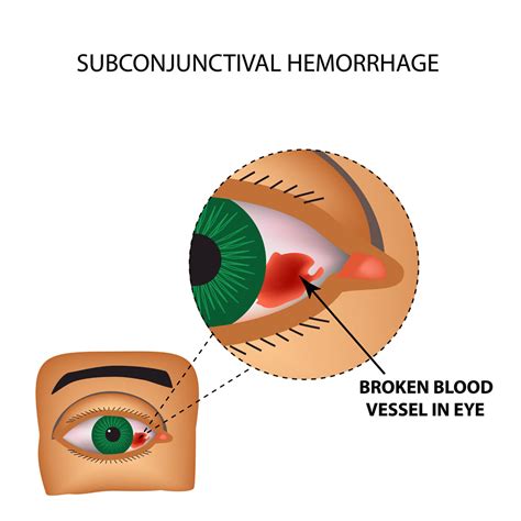 Subconjunctival Hemorrhage Treatment Eye Drops | edu.svet.gob.gt