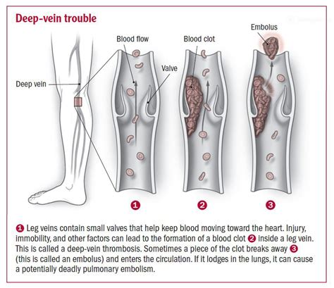 Deep vein thrombosis - Harvard Health