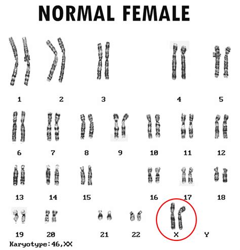 Turner Syndrome - Causes, Symptoms, Life Expectancy, Treatment