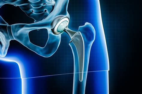 Hip Replacement Surgery and its types | Blog | Meril Life