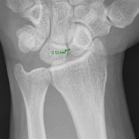 Measurement of scapholunate angle. 3) Ulnar variance (Figure 3) A line ...