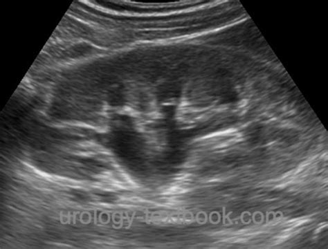 Ureter Ultrasound: Sonography of Hydronephrosis