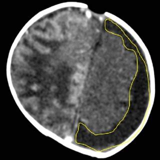 Figure 1 Mid-anterior coronal cranial ultrasound scan of a normal full ...