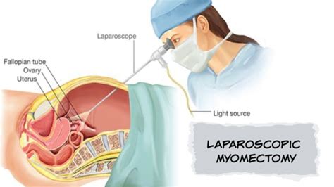 Laparoscopic Myomectomy Surgery Doctor in Dubai