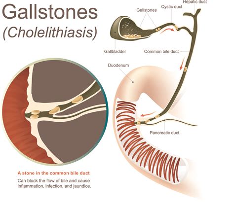 Symptoms of a Gallbladder Attack - Beaumont Emergency Hospital