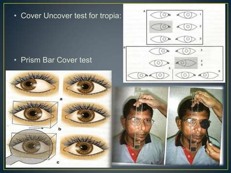 Strabismus-Clinical Examinations