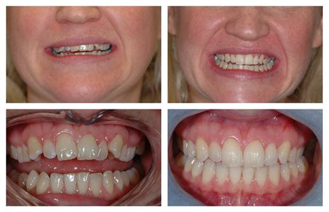 6 Month Smiles, Braces Surrey - Teeth Straightening Treatment