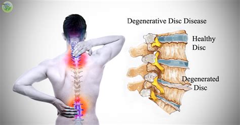 Degenerative Disc – Disc Clinic BC