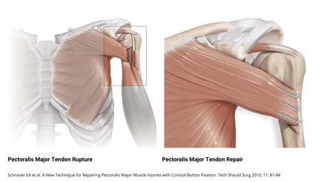 Pectoralis Major Tendon Ruptures | Dr. Edward S. Chang, MD